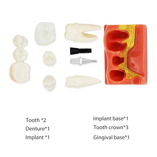 Модел на заби на заби Д-ИП, транспарентен стоматолошки имплантација на заби модел Стоматолошка стандардна болест Отстранлив