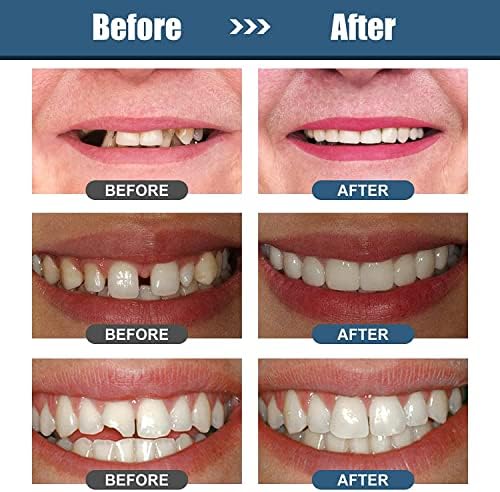 Гранули за поправка на забите, привремена комплет за поправка на забите, термички монистра со мовли, заби, поправени празнини
